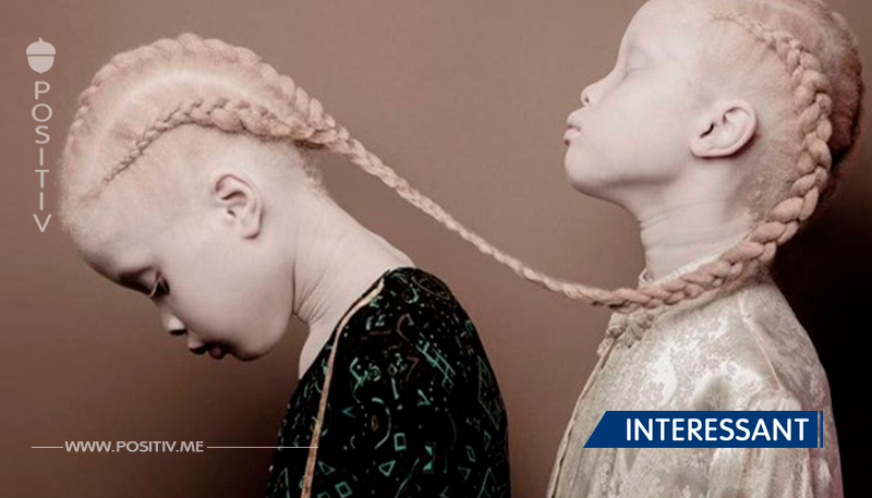 Zwilllingsschwestern mit Albinismus erobern Modewelt.