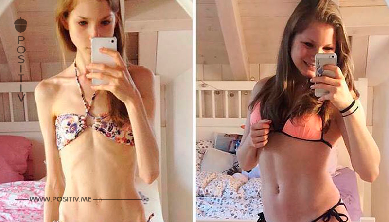 13 Fotos von Frauen, die ihre Magersucht besiegt haben. 