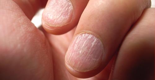 5 Gründe für brüchige Fingernägel & wie du die Nägel rettest