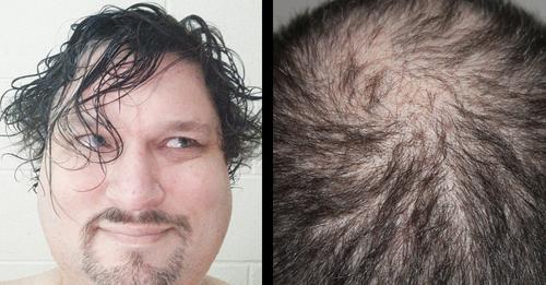 Haare nicht mehr waschen: Hilft No Poo gegen Haarausfall?